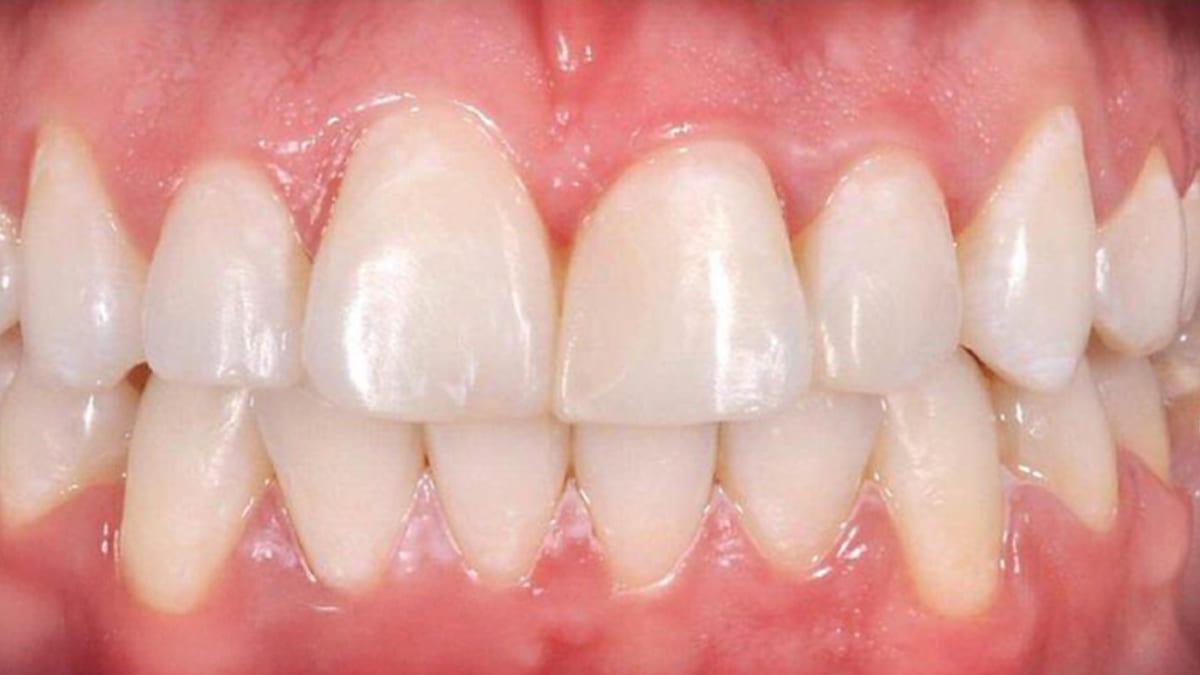 Case 1 after Invisalign® clear aligners: straighter, evenly spaced teeth