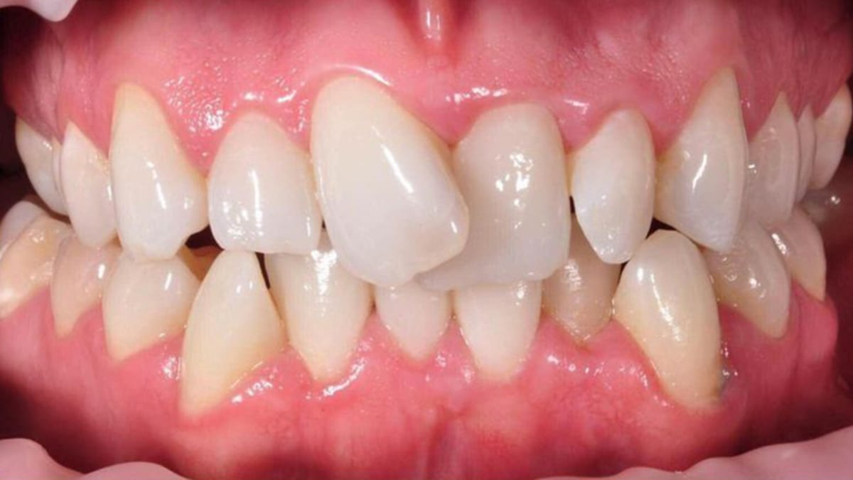 Case 1 before Invisalign® clear aligners