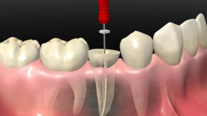 Root Canal Therapy