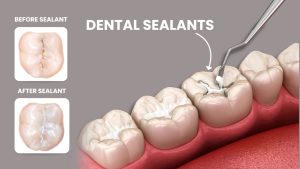 Dental Sealants