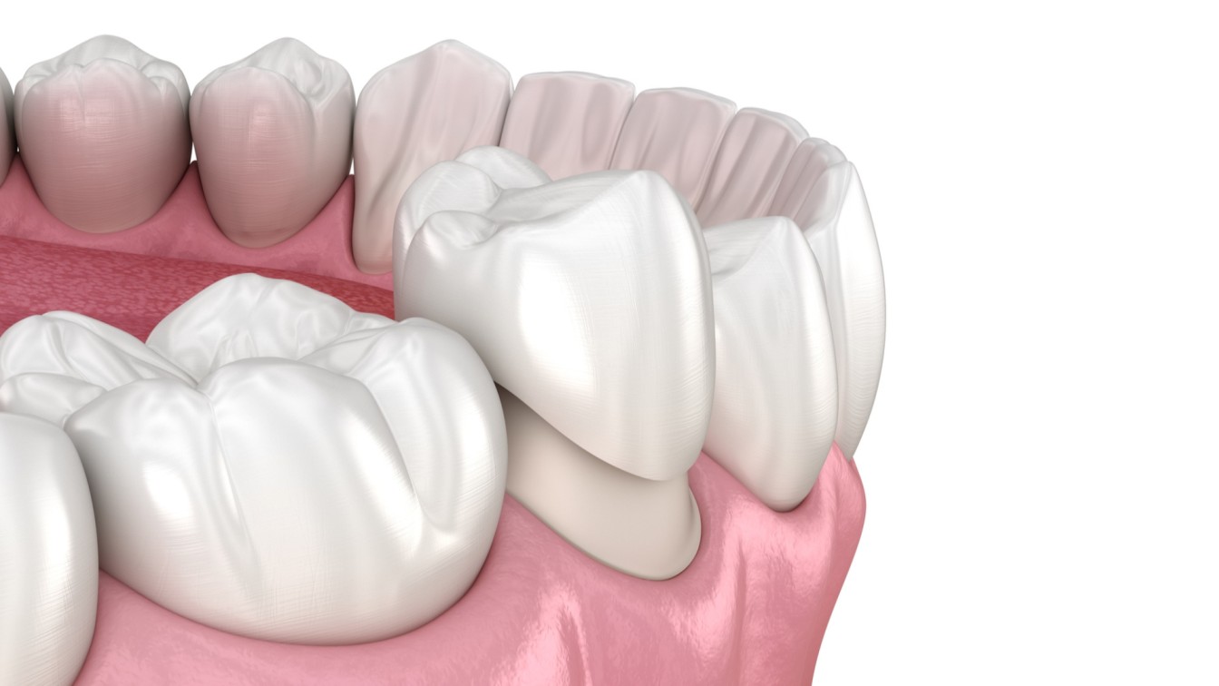 Dental Crown